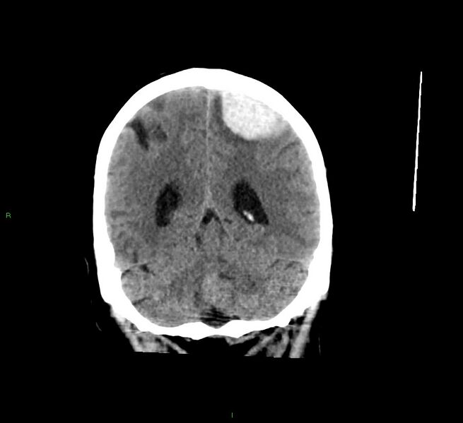File:Cerebral amyloid angiopathy-associated lobar intracerebral hemorrhage (Radiopaedia 58529-65681 Coronal non-contrast 21).jpg