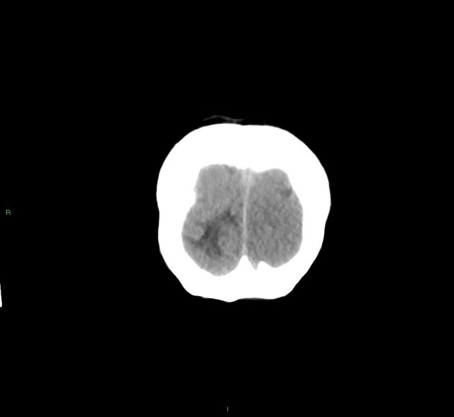 File:Cerebral amyloid angiopathy-associated lobar intracerebral hemorrhage (Radiopaedia 58561-65724 Coronal non-contrast 8).jpg
