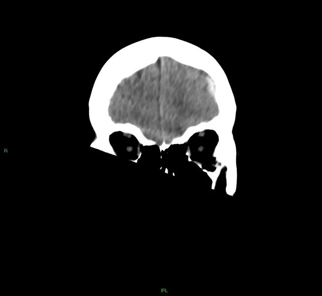 File:Cerebral amyloid angiopathy-associated lobar intracerebral hemorrhage (Radiopaedia 58754-65975 Coronal non-contrast 50).jpg