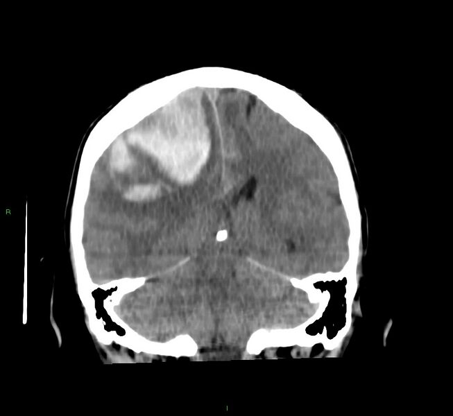 File:Cerebral amyloid angiopathy-associated lobar intracerebral hemorrhage (Radiopaedia 58756-65977 Coronal non-contrast 28).jpg