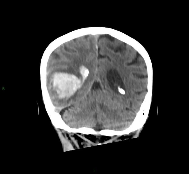 File:Cerebral amyloid angiopathy-associated lobar intracerebral hemorrhage (Radiopaedia 58758-65980 Coronal non-contrast 22).jpg