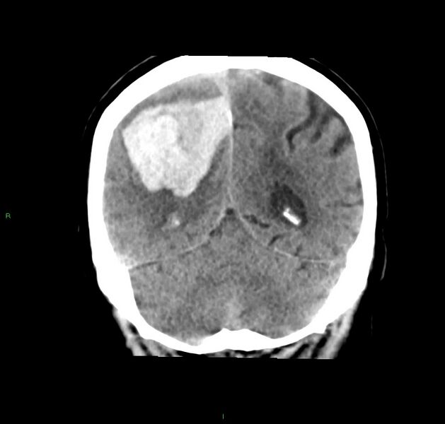 File:Cerebral amyloid angiopathy-associated lobar intracerebral hemorrhage (Radiopaedia 59356-66716 Coronal non-contrast 21).jpg