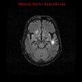 Cerebral and orbital tuberculomas (Radiopaedia 13308-13311 Axial FLAIR 9).jpg