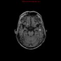 Cerebral and orbital tuberculomas (Radiopaedia 13308-13311 Axial T1 C+ 8).jpg