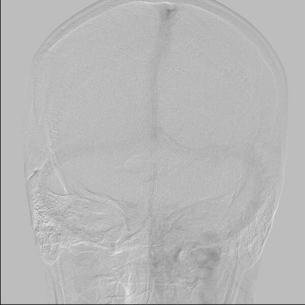 File:Cerebral aneurysm with rupture (Radiopaedia 29933-30458 LT CCA IC 26).jpg