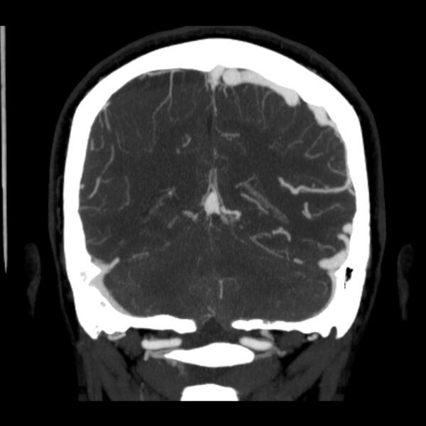 File:Cerebral arteriovenous malformation (Radiopaedia 43729-47189 C 34).jpg