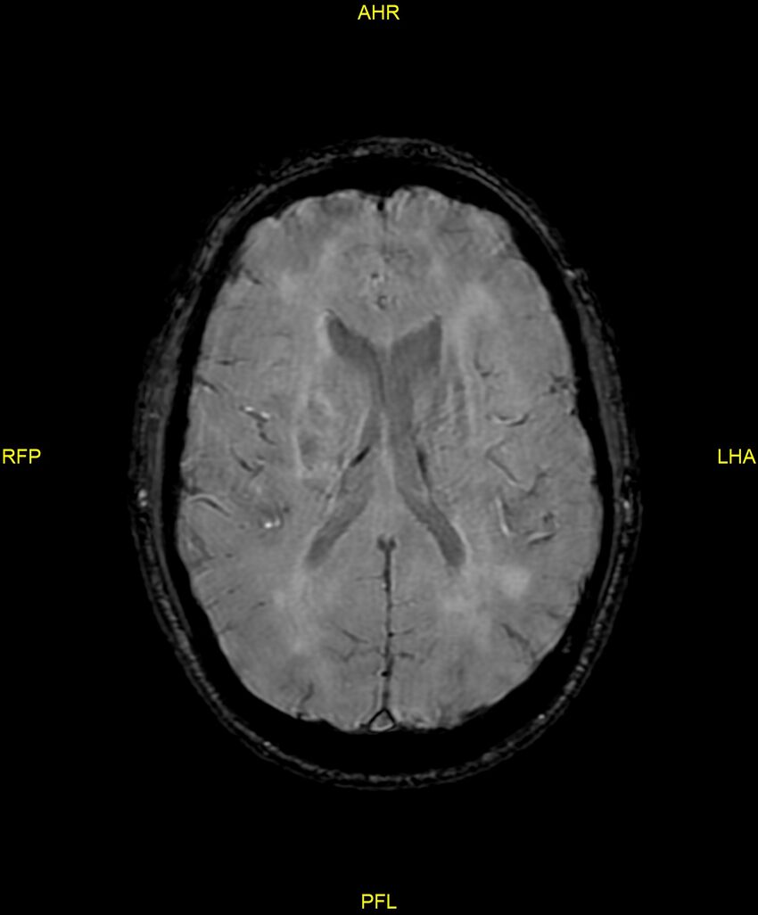 Cerebral autosomal dominant arteriopathy with subcortical infarcts and leukoencephalopathy (CADASIL) (Radiopaedia 86108-102054 Axial SWI 64).jpg