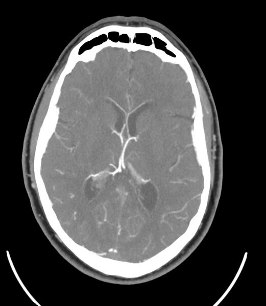 File:Cerebral dural venous sinus thrombosis (Radiopaedia 86514-102576 A 58).jpg