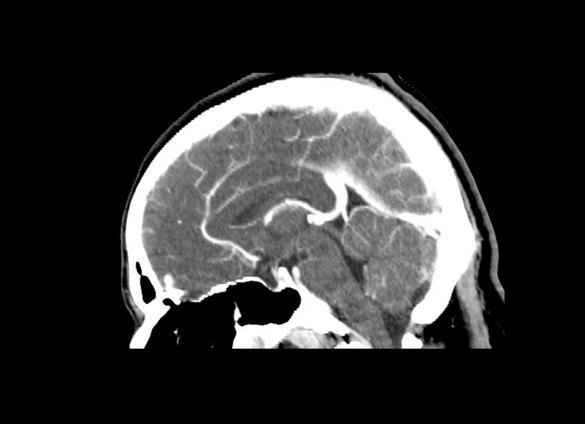 Cerebral edema (Radiopaedia 82519-96661 D 28).jpg