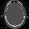 Cerebral hemorrhagic contusion with subdural and subarachnoid hemorrhage (Radiopaedia 10680-11146 Axial bone window 13).jpg