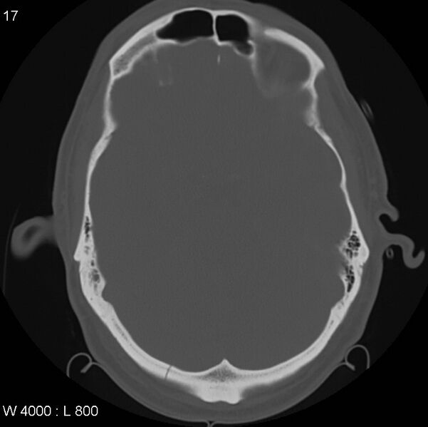 File:Cerebral hemorrhagic contusion with subdural and subarachnoid hemorrhage (Radiopaedia 10680-11146 Axial bone window 13).jpg