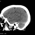 Cerebral hemorrhagic contusion with subdural and subarachnoid hemorrhage (Radiopaedia 10680-11146 C 2).jpg