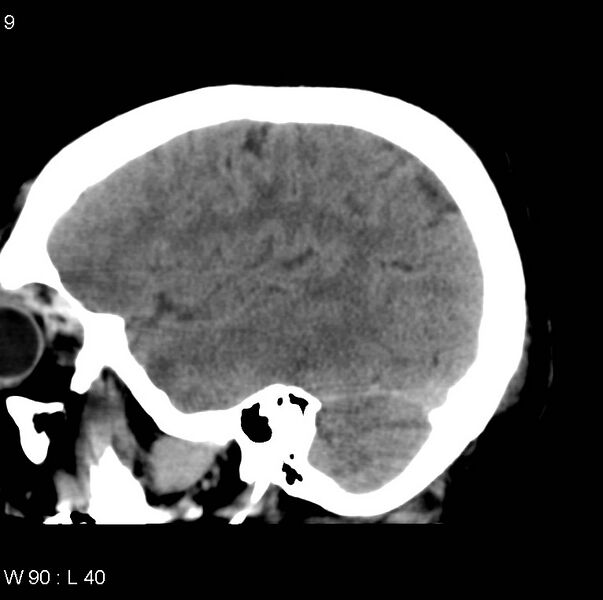 File:Cerebral hemorrhagic contusion with subdural and subarachnoid hemorrhage (Radiopaedia 10680-11146 C 2).jpg