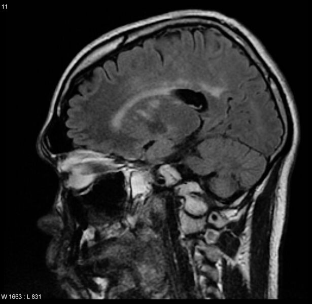 File:Cerebral vasculitis (Radiopaedia 5131-6923 Sagittal FLAIR 3).jpg