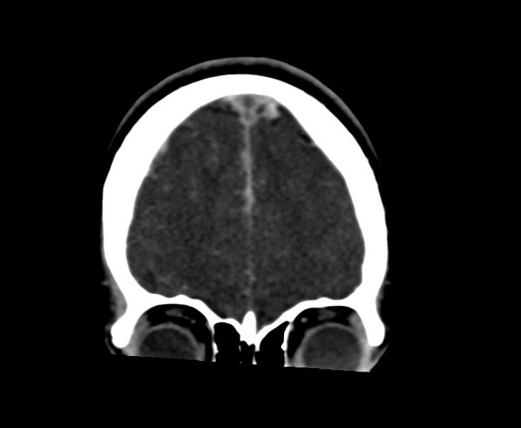File:Cerebral venous sinus thrombosis (Radiopaedia 59224-66646 Coronal C+ delayed 10).jpg