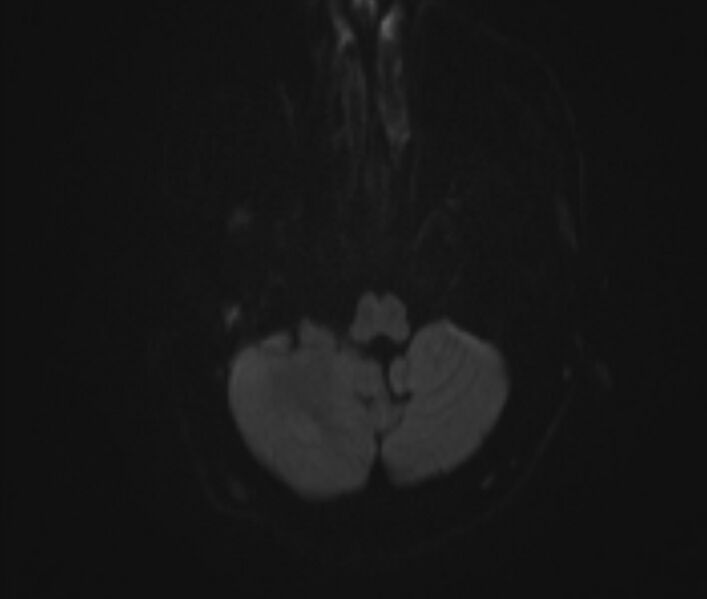 File:Cerebral venous thrombosis (Radiopaedia 71207-81504 Axial DWI 3).jpg