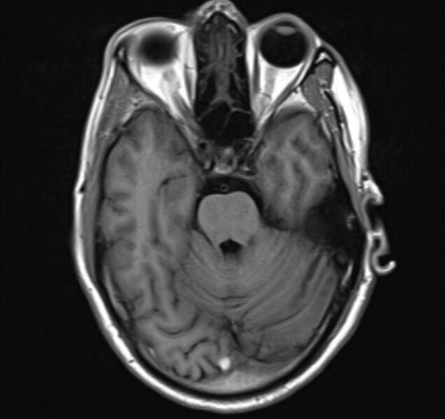 File:Cerebral venous thrombosis (Radiopaedia 71207-81504 Axial T1 9).jpg