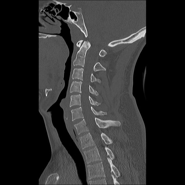 File:Cervical facet fracture and anterior discoligamentous injury (Radiopaedia 32139-33083 Sagittal bone window 20).jpg
