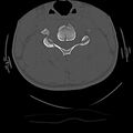 Cervical flexion teardrop fracture with cord hemorrhage (Radiopaedia 32497-33454 Axial bone window 45).jpg