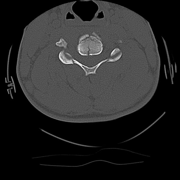 File:Cervical flexion teardrop fracture with cord hemorrhage (Radiopaedia 32497-33454 Axial bone window 45).jpg