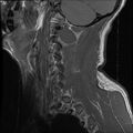 Cervical flexion teardrop fracture with cord hemorrhage (Radiopaedia 32497-33455 Sagittal T1 18).jpg
