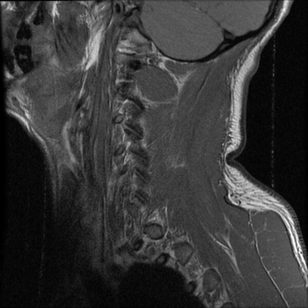 File:Cervical flexion teardrop fracture with cord hemorrhage (Radiopaedia 32497-33455 Sagittal T1 18).jpg