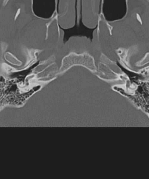 File:Cervical intercalary bone (Radiopaedia 35211-36748 Axial bone window 2).png