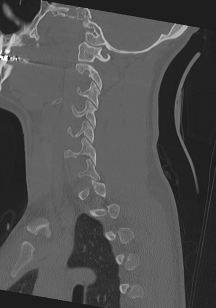 File:Cervical intercalary bone (Radiopaedia 35211-36748 Sagittal bone window 55).png