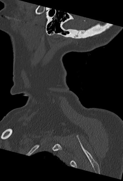 File:Cervical spine ACDF loosening (Radiopaedia 48998-54070 Sagittal bone window 8).png