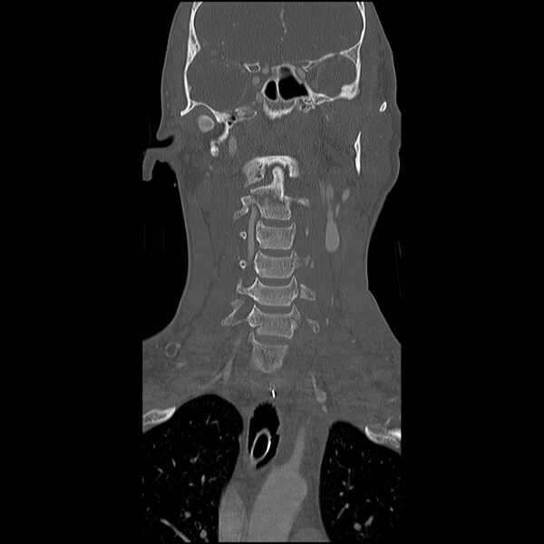 File:Cervical spine fractures with vertebral artery dissection (Radiopaedia 32135-33078 Coronal bone window 7).jpg