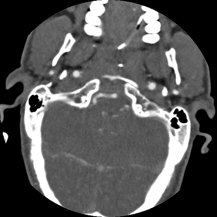 Cervical spine fractures with vertebral artery dissection (Radiopaedia 32135-33078 D 72).jpg