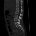 Chance fracture with duodenal and pancreatic lacerations (Radiopaedia 43477-50042 Sagittal bone window 9).jpg