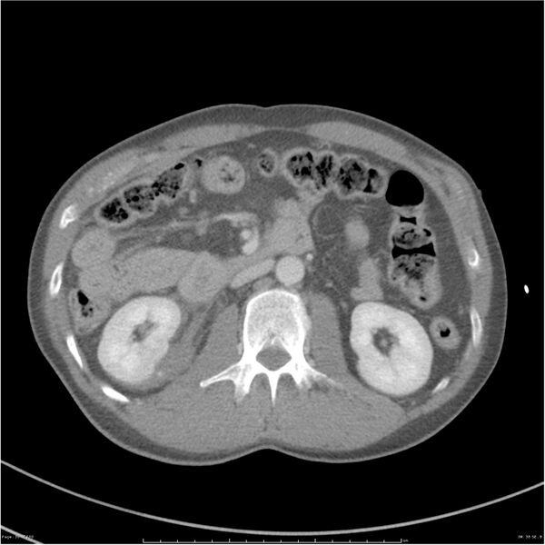 File:Chest and abdomen multi-trauma (Radiopaedia 26294-26426 A 38).jpg