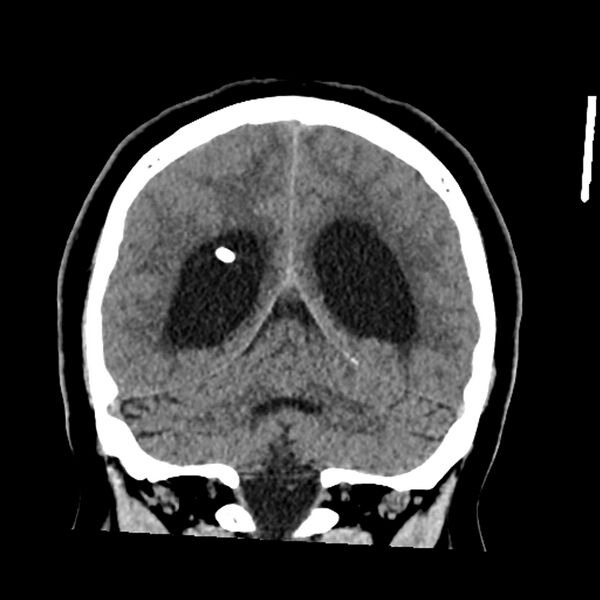 File:Chiasmatic-hypothalamic juvenile pilocytic astrocytoma (Radiopaedia 78533-91237 Coronal non-contrast 49).jpg