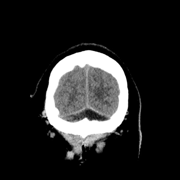 File:Chiasmatic-hypothalamic juvenile pilocytic astrocytoma (Radiopaedia 78533-91237 Coronal non-contrast 63).jpg