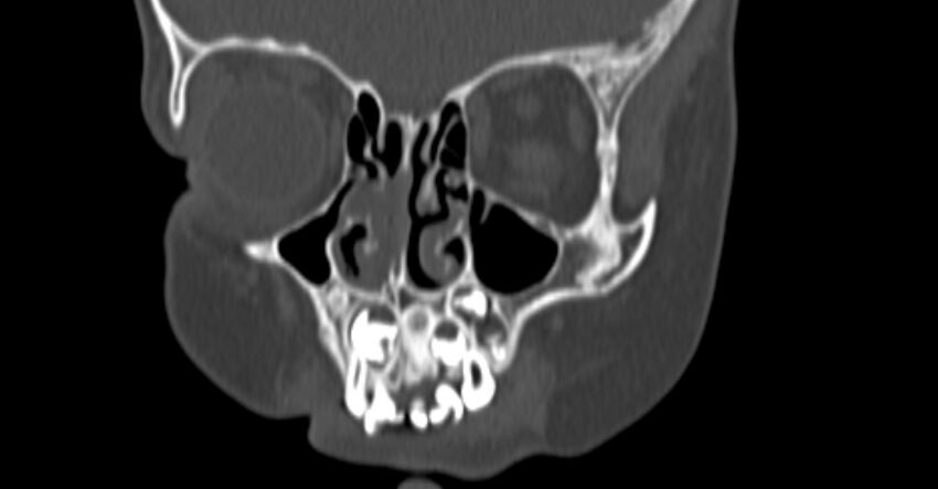 Choanal atresia (Radiopaedia 51295-56972 Coronal bone window 19).jpg