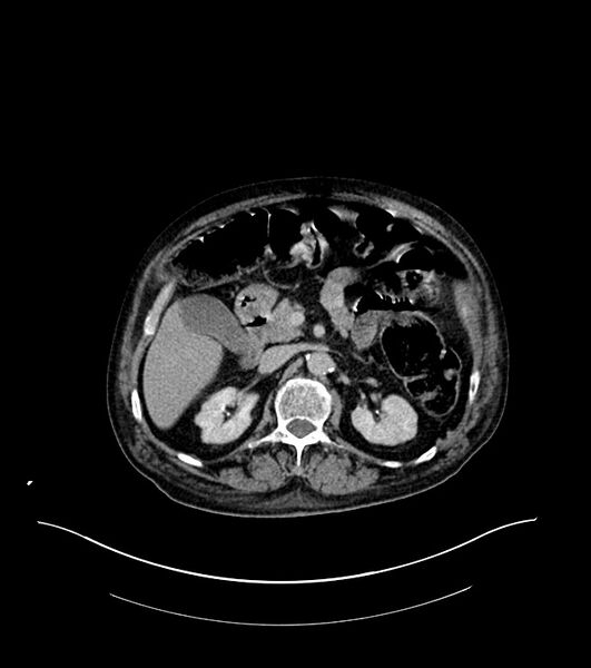 File:Cholangiocarcinoma with cerebral metastases (Radiopaedia 83519-98629 Axial C+ delayed 40).jpg