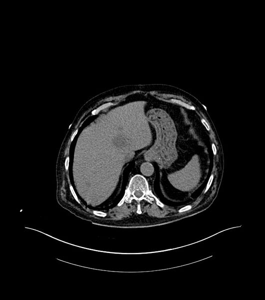 File:Cholangiocarcinoma with cerebral metastases (Radiopaedia 83519-98629 Axial non-contrast 14).jpg