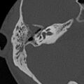 Cholesteatoma (Radiopaedia 15846-15494 bone window 12).jpg