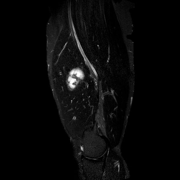 File:Chondrosarcoma arising from exostosis (Radiopaedia 59996-67686 Sagittal STIR 16).jpg