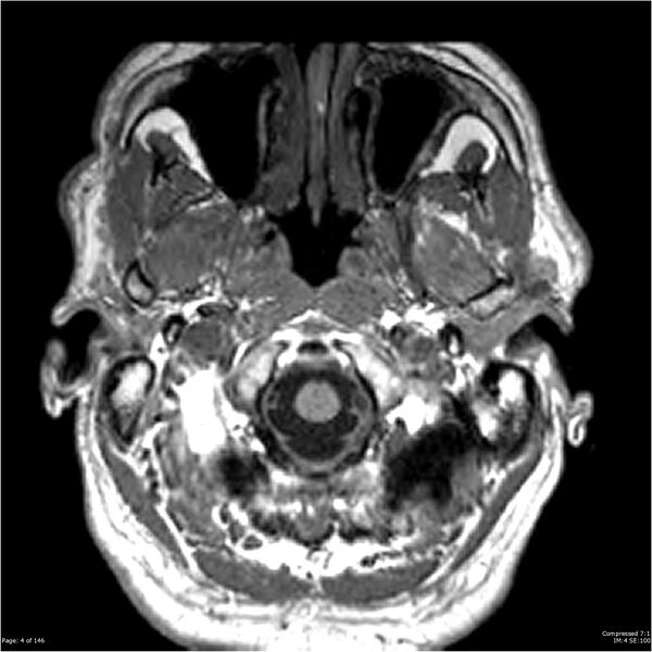 File:Chondrosarcoma of skull base- grade II (Radiopaedia 40948-43654 Axial T1 4).jpg