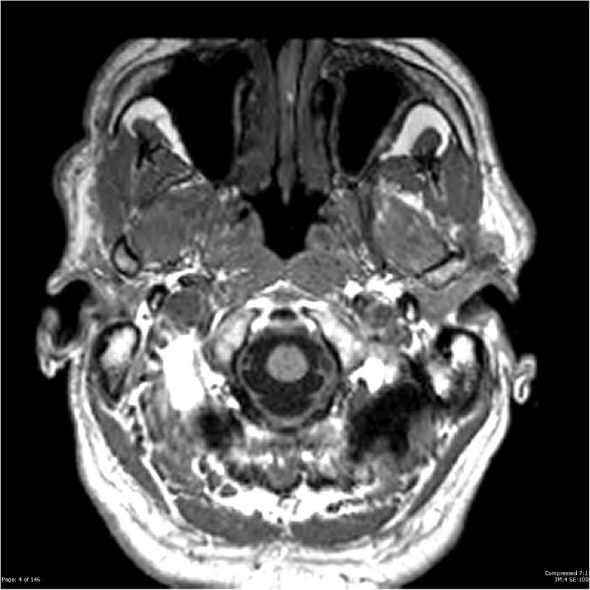 Chondrosarcoma of skull base- grade II (Radiopaedia 40948-43654 Axial T1 4).jpg