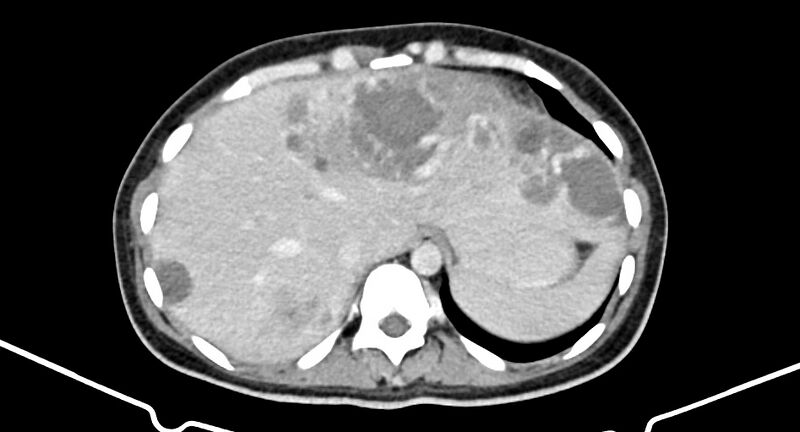 File:Choriocarcinoma liver metastases (Radiopaedia 74768-85766 A 41).jpg