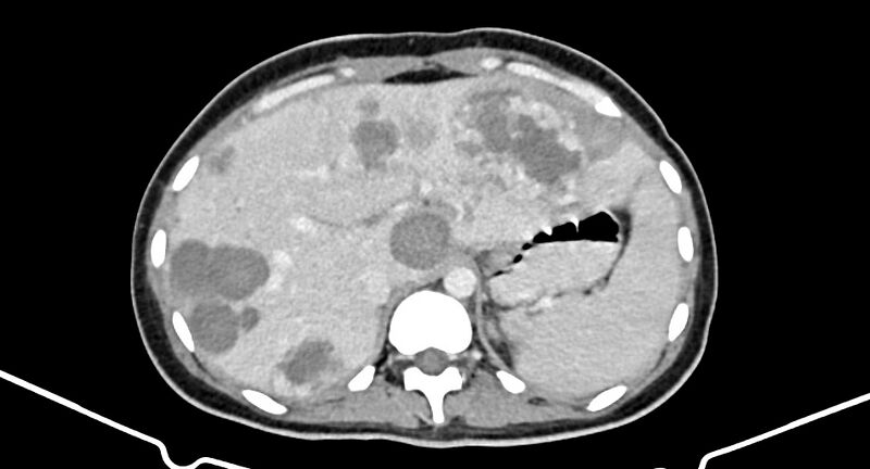 File:Choriocarcinoma liver metastases (Radiopaedia 74768-85766 A 57).jpg