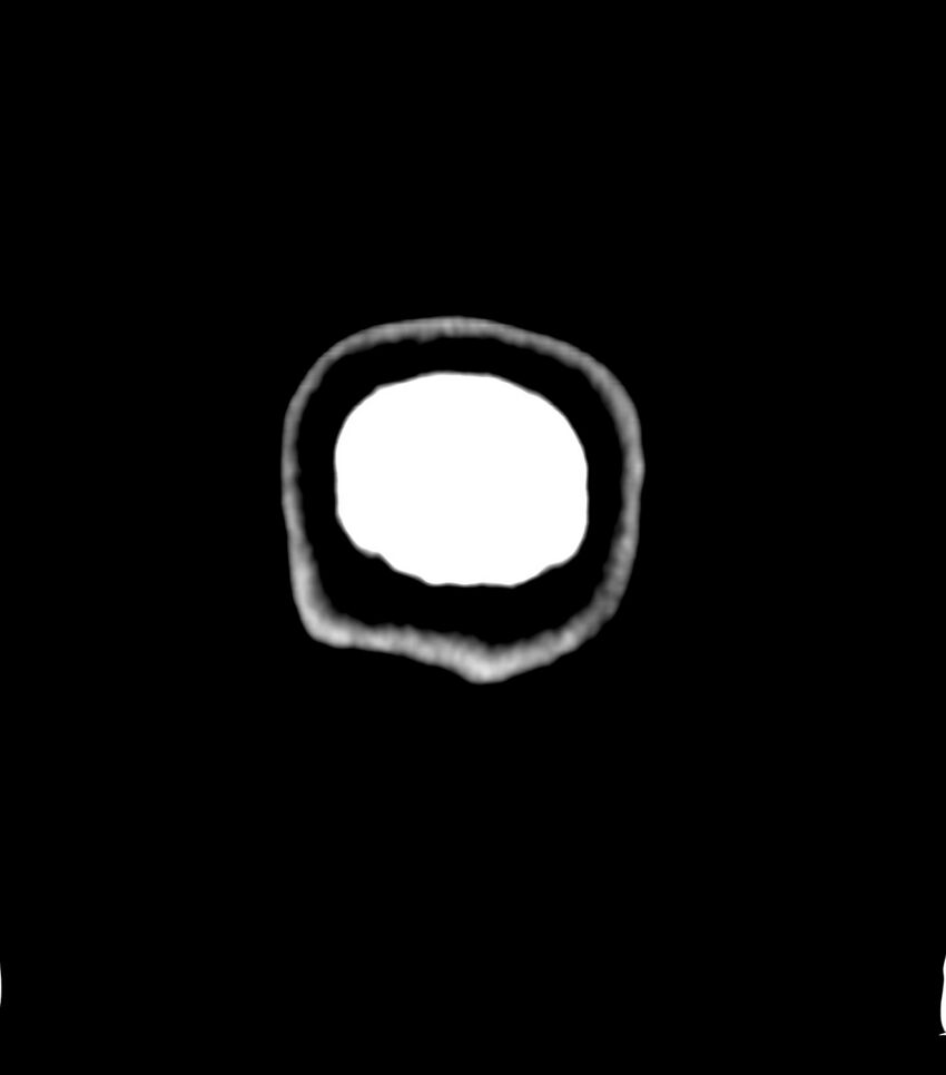 Choroid plexus carcinoma (Radiopaedia 91013-108552 Coronal non-contrast 88).jpg