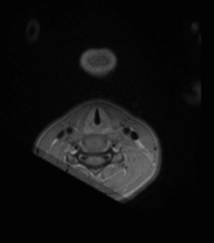 Choroid plexus carcinoma (Radiopaedia 91013-108553 Axial T1 C+ 1).jpg