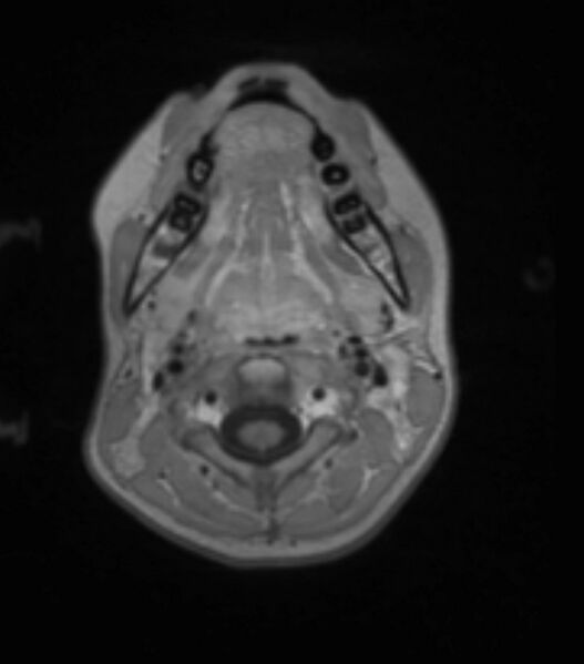 File:Choroid plexus carcinoma (Radiopaedia 91013-108553 Axial T1 C+ 35).jpg