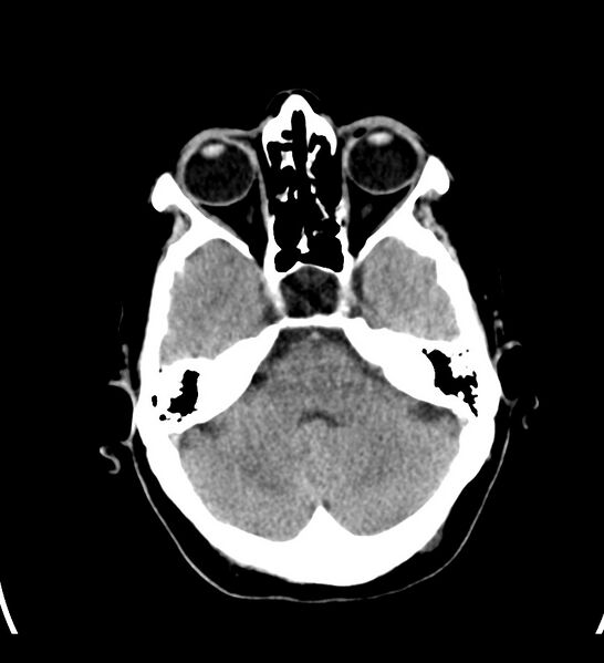 File:Choroid plexus xanthogranuloma (Radiopaedia 91271-108874 Axial non-contrast 11).jpg