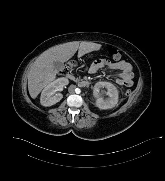 File:Chromophobe renal cell carcinoma (Radiopaedia 84239-99519 B 54).jpg