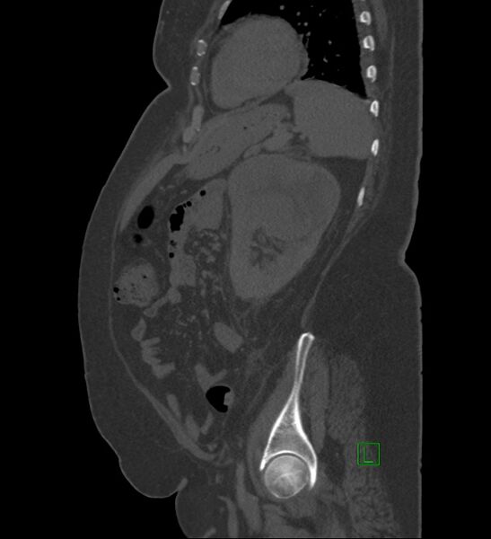 File:Chromophobe renal cell carcinoma (Radiopaedia 84239-99519 Sagittal bone window 28).jpg